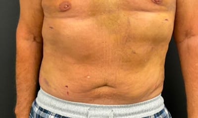 Liposuction & SmartLipo Before & After Gallery - Patient 306947 - Image 2