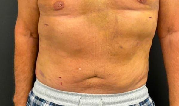 Liposuction & SmartLipo Before & After Gallery - Patient 306947 - Image 2