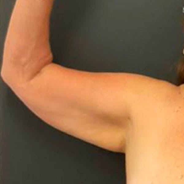 Liposuction & SmartLipo Before & After Gallery - Patient 217727 - Image 1