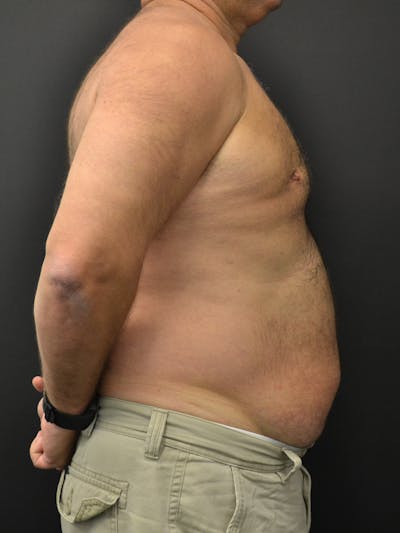 Liposuction & SmartLipo Before & After Gallery - Patient 103932 - Image 1