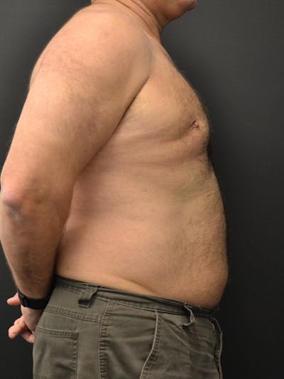 Liposuction & SmartLipo Before & After Gallery - Patient 103932 - Image 2