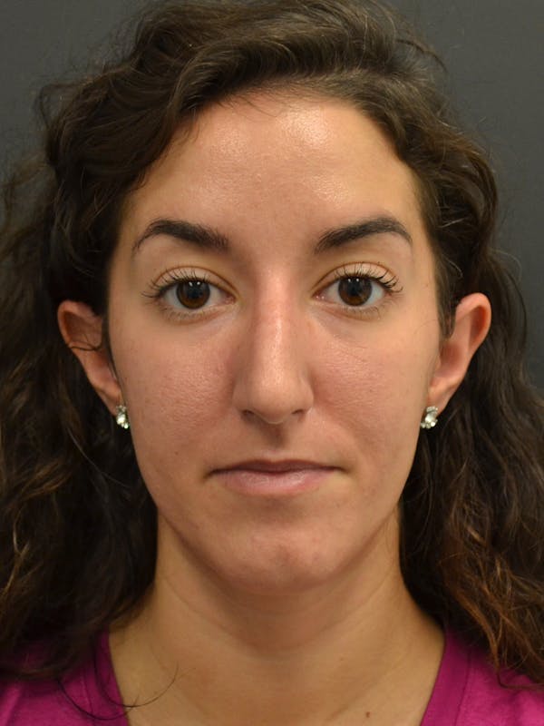 Rhinoplasty Before & After Gallery - Patient 717658 - Image 3