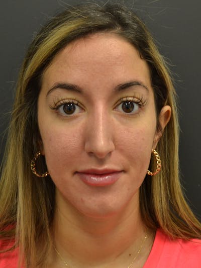 Rhinoplasty Before & After Gallery - Patient 717658 - Image 4