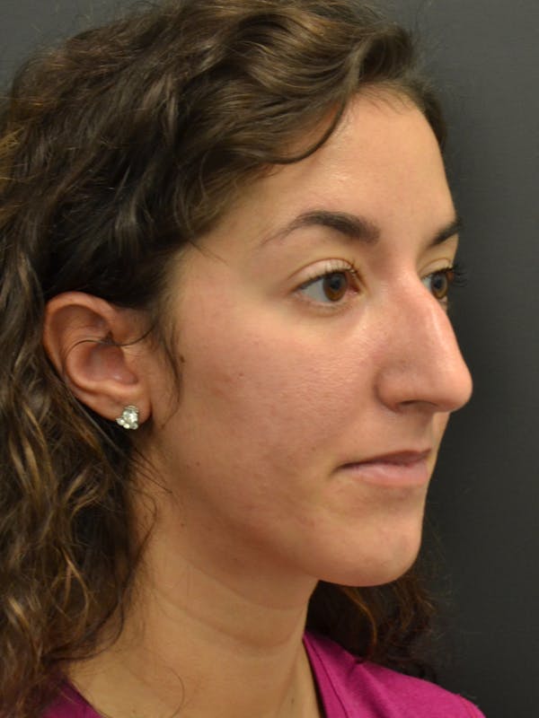 Rhinoplasty Before & After Gallery - Patient 717658 - Image 5