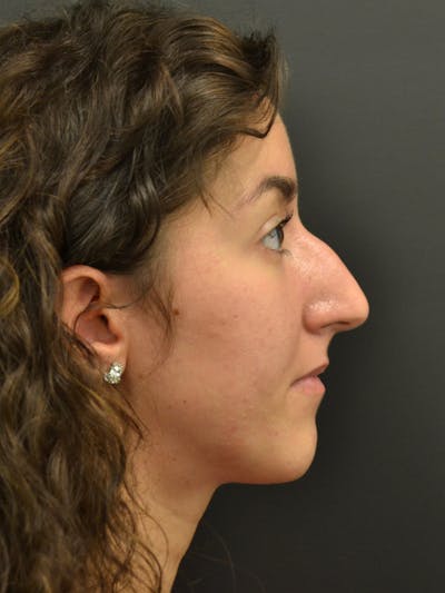 Rhinoplasty Before & After Gallery - Patient 717658 - Image 1