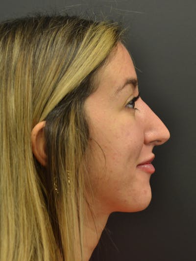 Rhinoplasty Before & After Gallery - Patient 717658 - Image 2