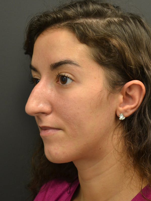 Rhinoplasty Before & After Gallery - Patient 717658 - Image 7
