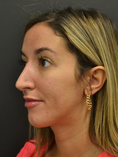 Rhinoplasty Before & After Gallery - Patient 717658 - Image 8