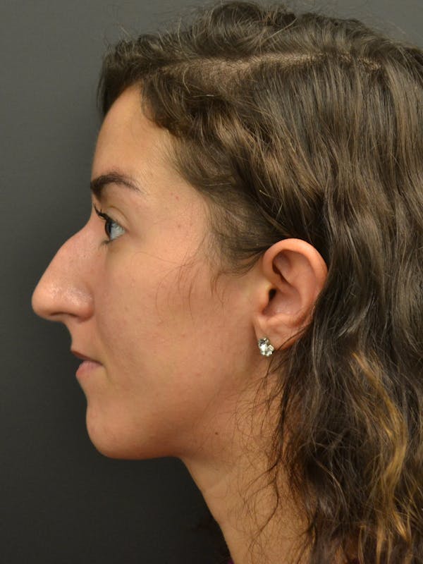 Rhinoplasty Before & After Gallery - Patient 717658 - Image 9