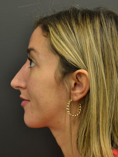 Rhinoplasty Before & After Gallery - Patient 717658 - Image 10
