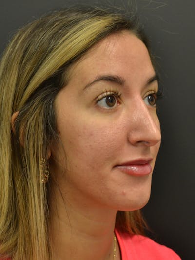 Rhinoplasty Before & After Gallery - Patient 717658 - Image 6