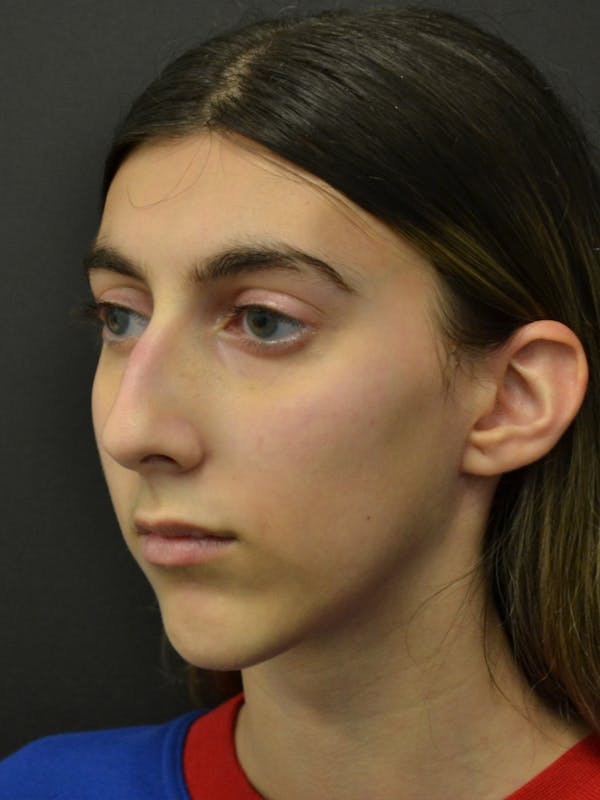 Rhinoplasty Before & After Gallery - Patient 285374 - Image 7