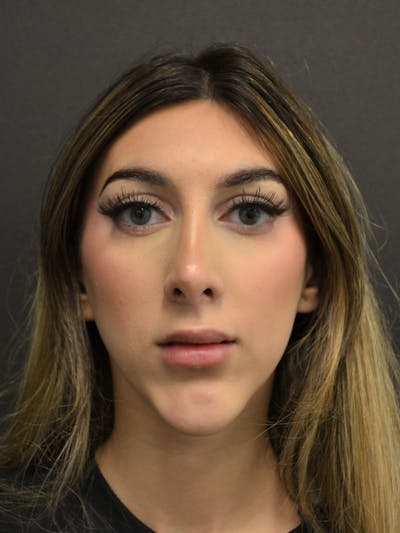 Rhinoplasty Before & After Gallery - Patient 285374 - Image 4