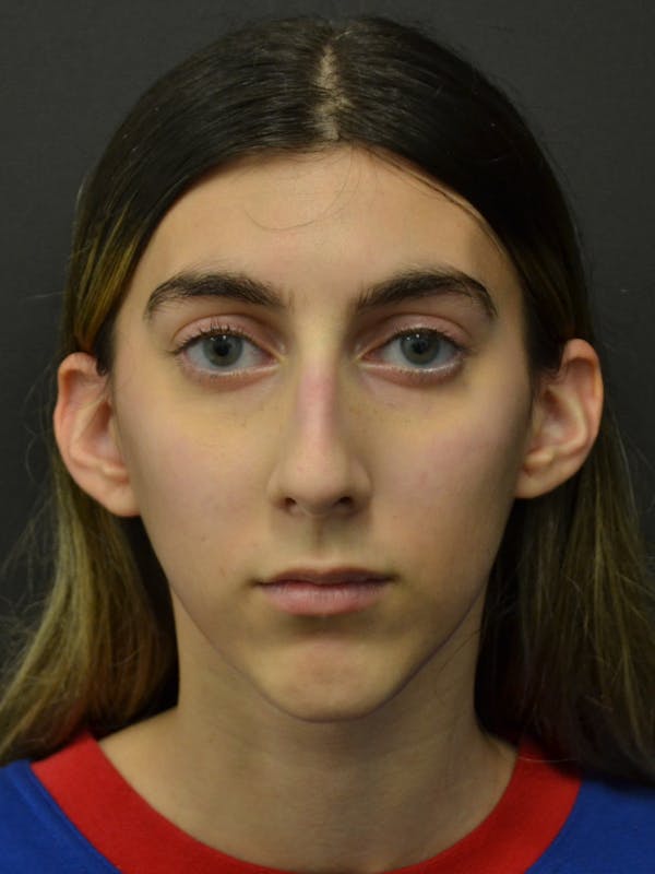 Rhinoplasty Before & After Gallery - Patient 285374 - Image 3