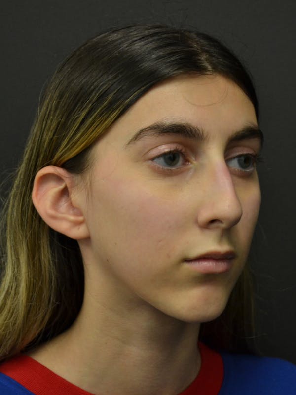 Rhinoplasty Before & After Gallery - Patient 285374 - Image 5