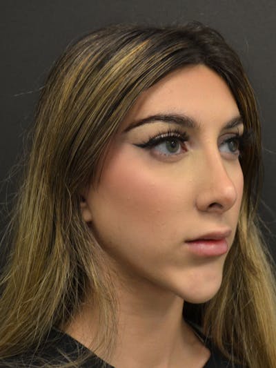 Rhinoplasty Before & After Gallery - Patient 285374 - Image 6