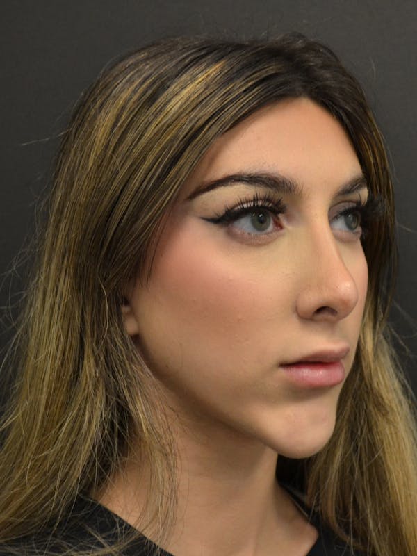Rhinoplasty Before & After Gallery - Patient 285374 - Image 6