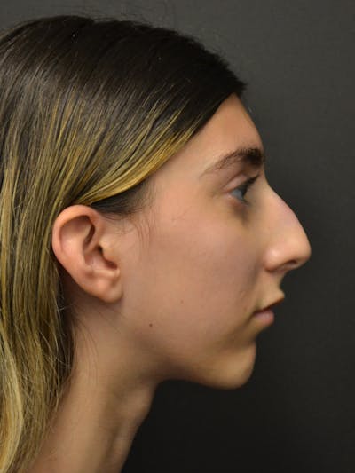 Rhinoplasty Before & After Gallery - Patient 285374 - Image 1