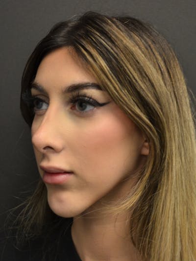 Rhinoplasty Before & After Gallery - Patient 285374 - Image 8