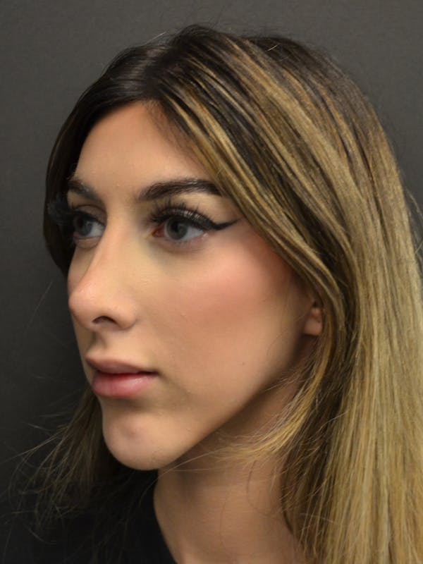 Rhinoplasty Before & After Gallery - Patient 285374 - Image 8