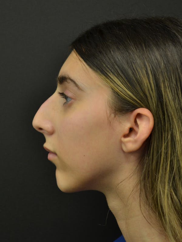 Rhinoplasty Before & After Gallery - Patient 285374 - Image 9