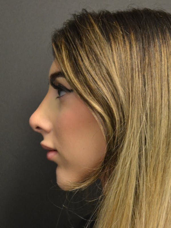Rhinoplasty Before & After Gallery - Patient 285374 - Image 10
