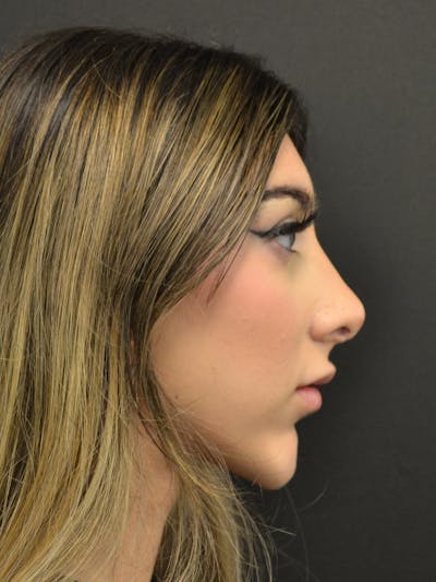 Rhinoplasty Before & After Gallery - Patient 285374 - Image 2