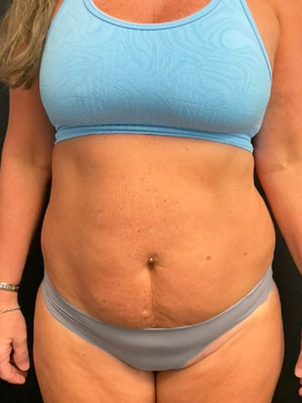 Tummy Tuck Before & After Gallery - Patient 336766 - Image 2