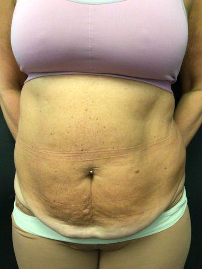 Tummy Tuck Before & After Gallery - Patient 336766 - Image 1
