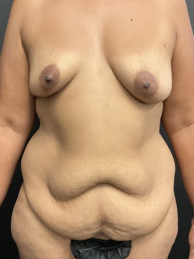 Tummy Tuck Before & After Gallery - Patient 133318 - Image 1