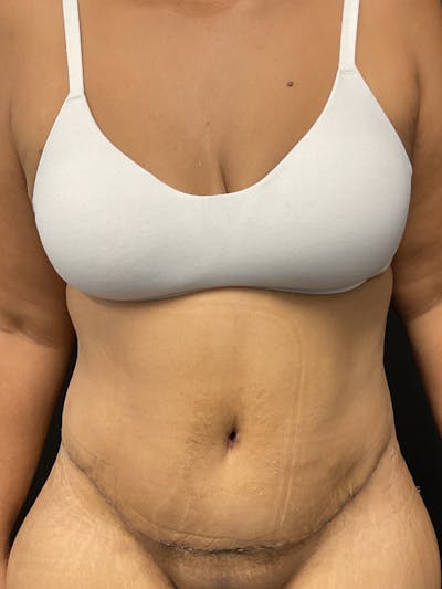 Tummy Tuck Before & After Gallery - Patient 133318 - Image 2