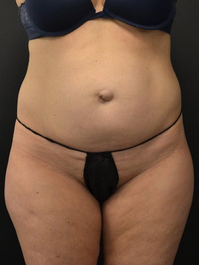 Tummy Tuck Before & After Gallery - Patient 274208 - Image 1