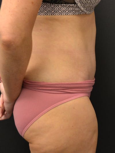 Tummy Tuck Before & After Gallery - Patient 274208 - Image 6