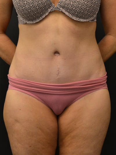 Tummy Tuck Before & After Gallery - Patient 274208 - Image 2