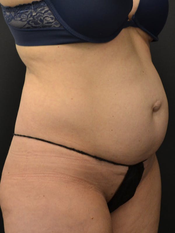 Tummy Tuck Before & After Gallery - Patient 274208 - Image 3