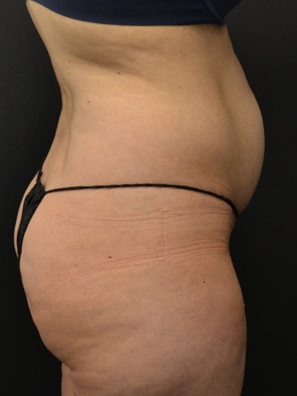Tummy Tuck Before & After Gallery - Patient 274208 - Image 5