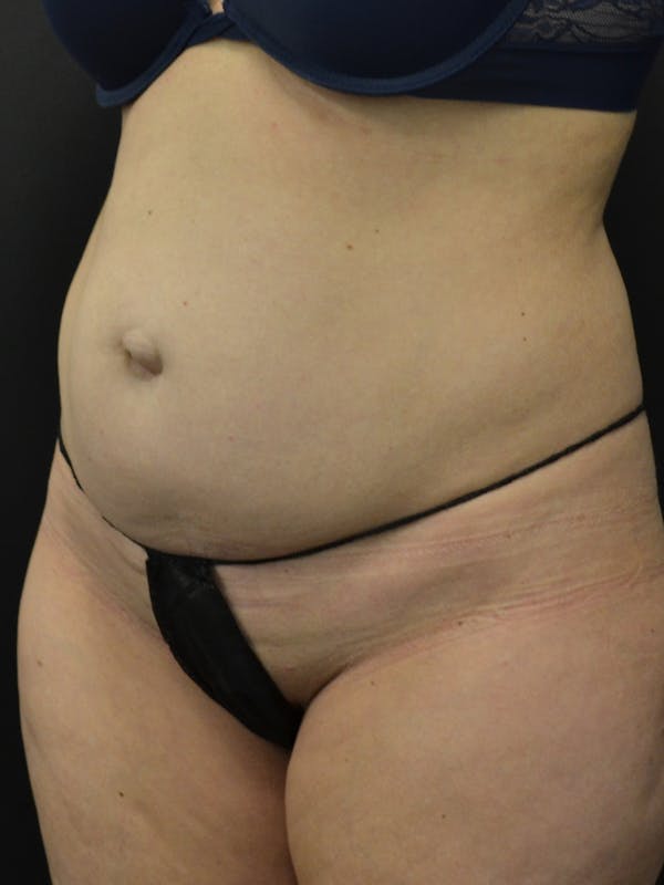 Tummy Tuck Before & After Gallery - Patient 274208 - Image 7