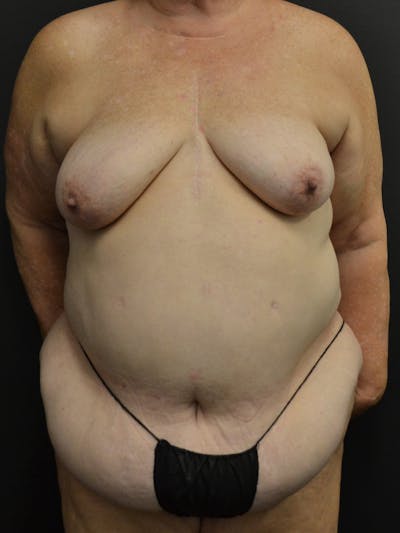 Tummy Tuck Before & After Gallery - Patient 268034 - Image 1