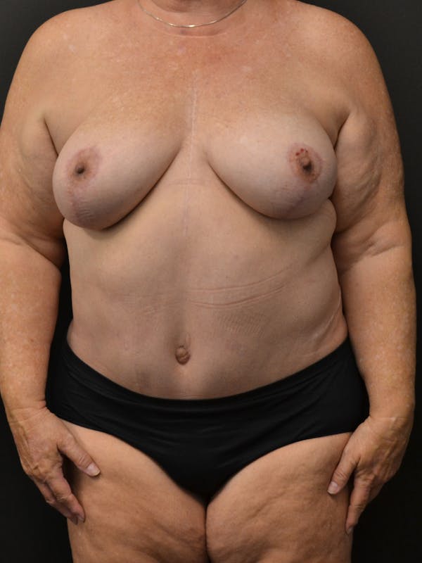Tummy Tuck Before & After Gallery - Patient 268034 - Image 2