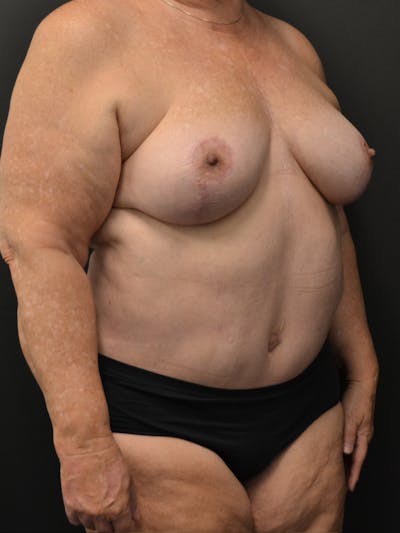 Tummy Tuck Before & After Gallery - Patient 268034 - Image 4