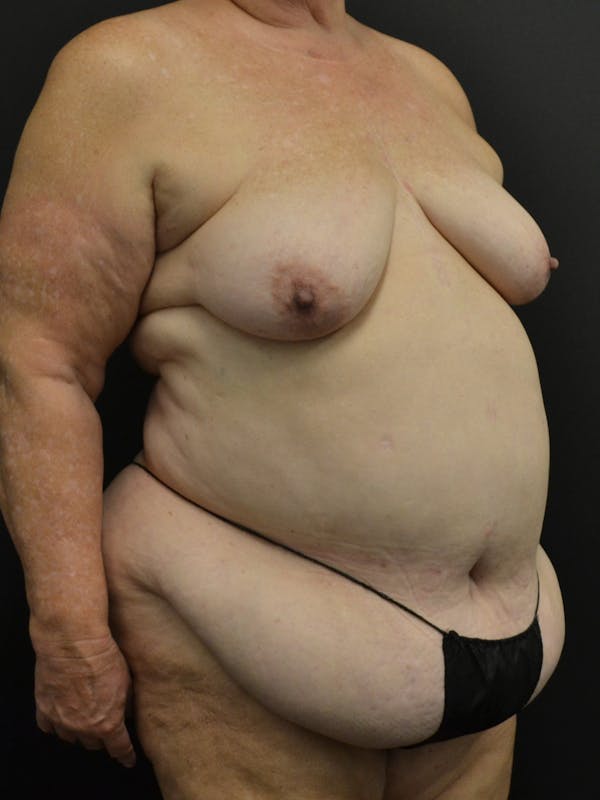 Tummy Tuck Before & After Gallery - Patient 268034 - Image 3