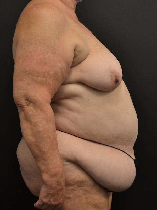 Tummy Tuck Before & After Gallery - Patient 268034 - Image 5