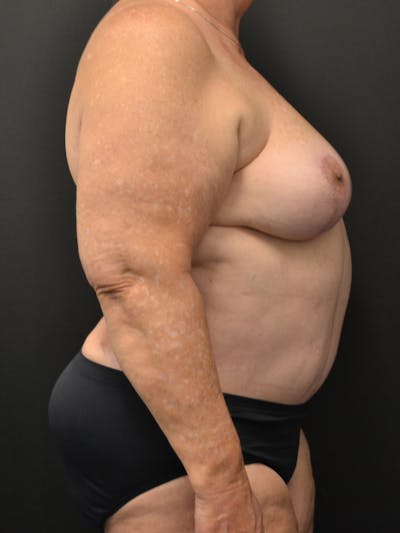 Tummy Tuck Before & After Gallery - Patient 268034 - Image 6