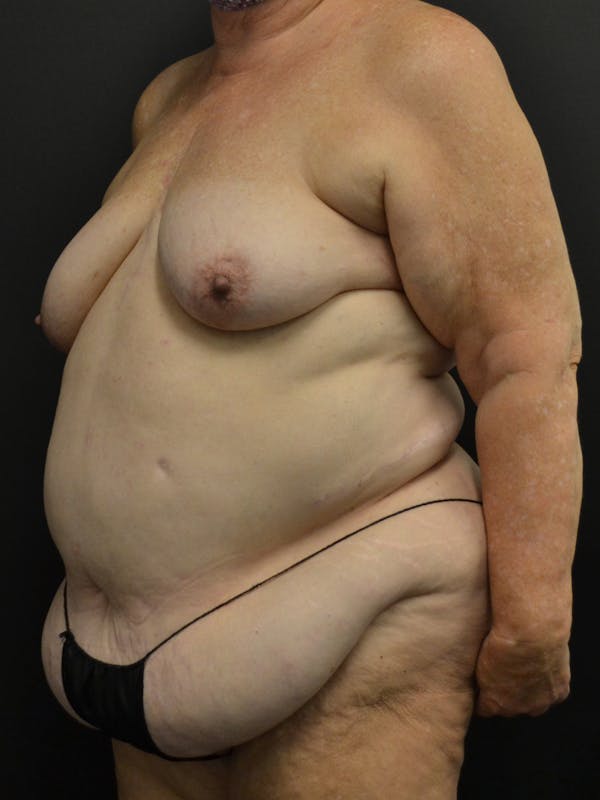 Tummy Tuck Before & After Gallery - Patient 268034 - Image 7