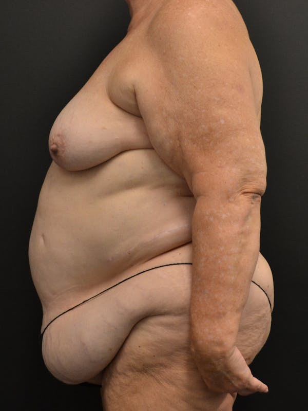 Tummy Tuck Before & After Gallery - Patient 268034 - Image 9