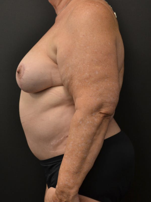 Tummy Tuck Before & After Gallery - Patient 268034 - Image 10