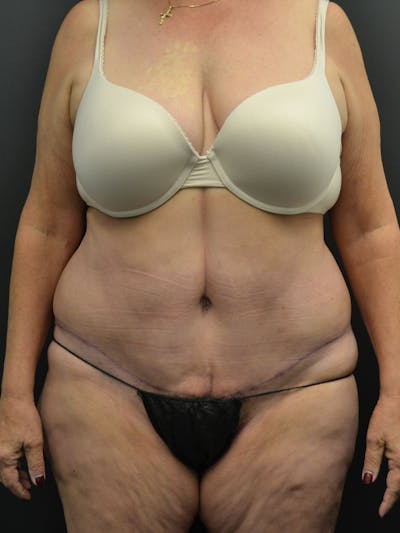 Tummy Tuck Before & After Gallery - Patient 220678 - Image 2