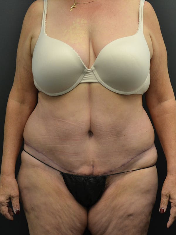 Tummy Tuck Before & After Gallery - Patient 220678 - Image 2
