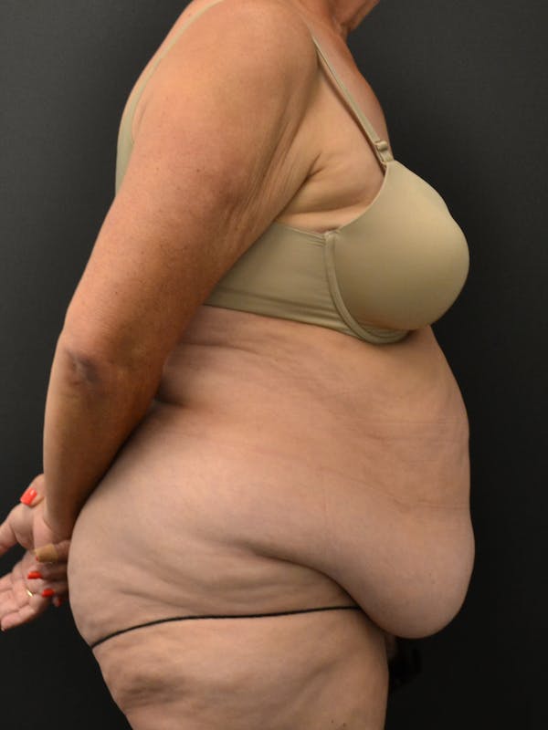 Tummy Tuck Before & After Gallery - Patient 220678 - Image 5