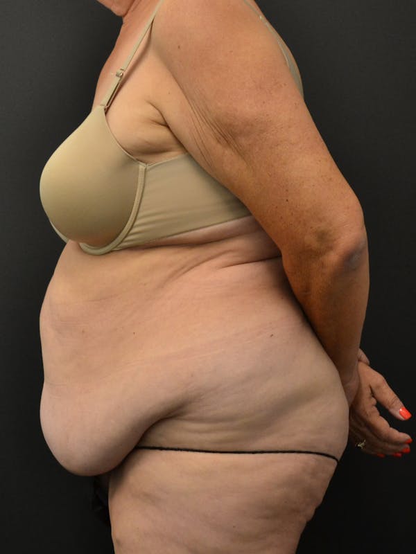 Tummy Tuck Before & After Gallery - Patient 220678 - Image 9